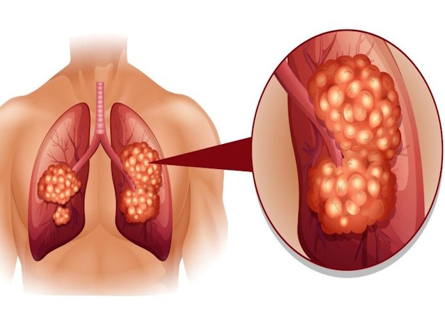lung cancer